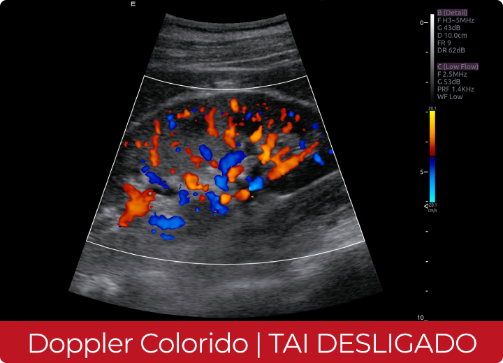 Sistema de Diagnóstico por Ultrassom Acclarix AX8 Innocare.DR - Doppler Colorido com TAI Desligado