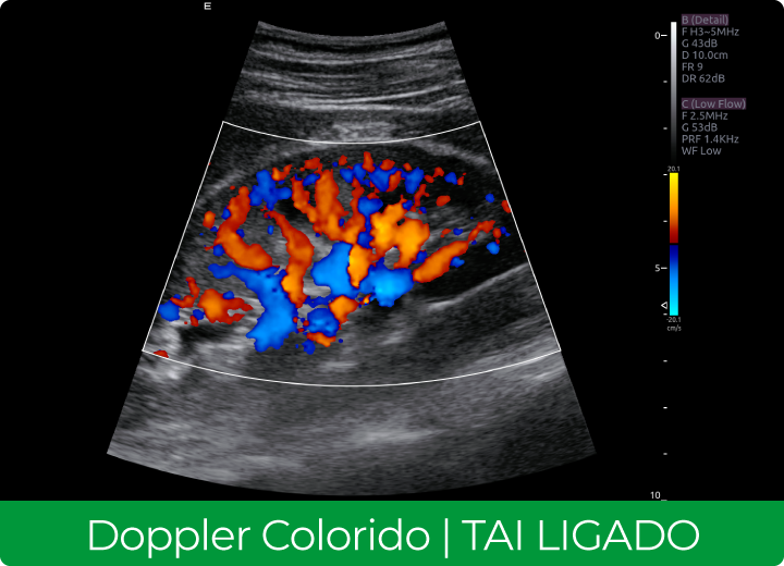 Sistema de Diagnóstico por Ultrassom Acclarix AX8 Innocare.DR - Doppler Colorido com TAI Ligado