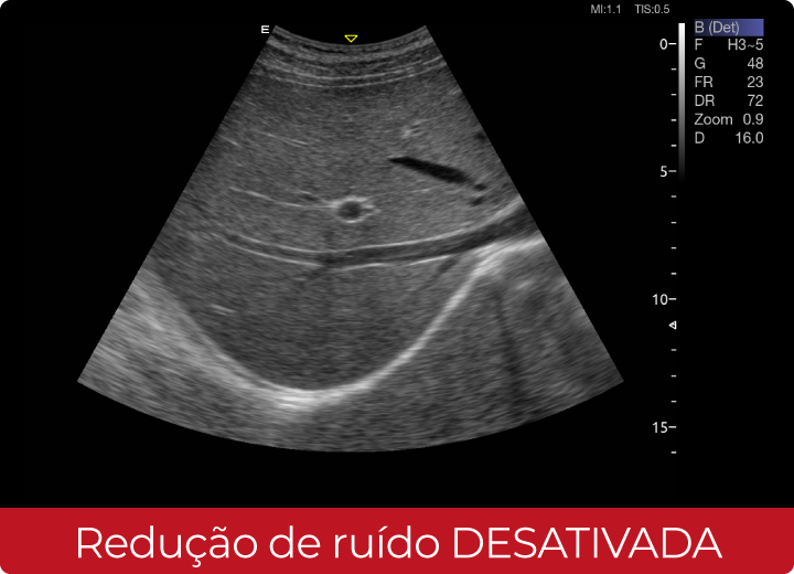 Sistema de Diagnóstico por Ultrassom Acclarix AX8 Innocare.DR - Redução de ruído desativada