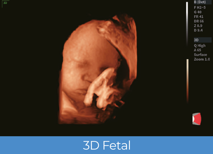 Sistema de Diagnóstico por Ultrassom Acclarix LX85 Innocare.DR - 3D Fetal