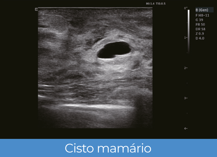 Sistema de Diagnóstico por Ultrassom Acclarix LX85 Innocare.DR - Cisto mamário