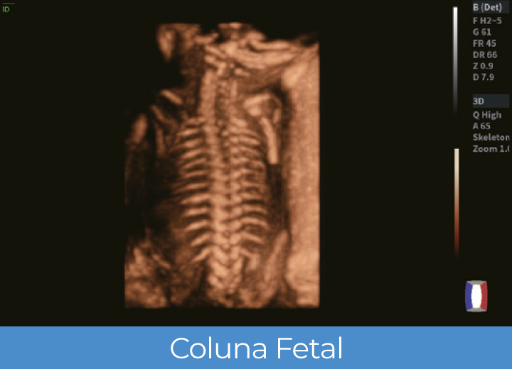 Sistema de Diagnóstico por Ultrassom Acclarix LX85 Innocare.DR - Coluna fetal
