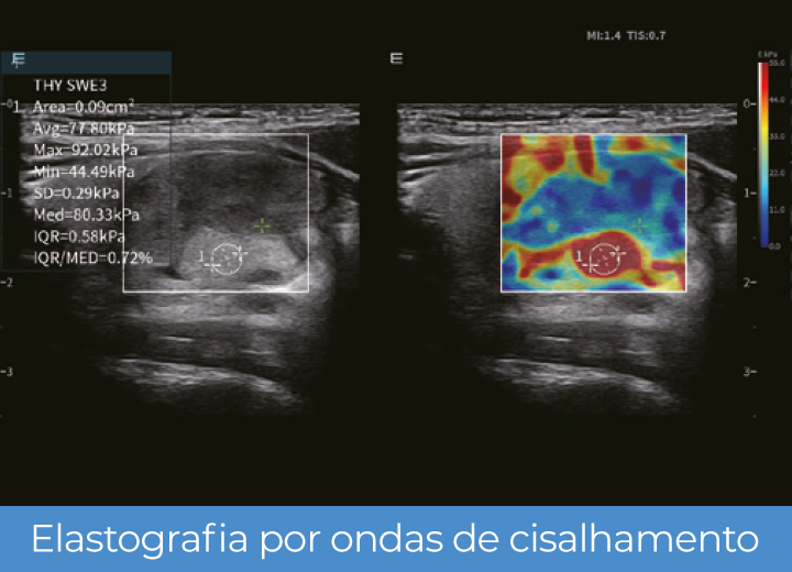 Sistema de Diagnóstico por Ultrassom Acclarix LX85 Innocare.DR - Elastograﬁa por ondas de cisalhamento