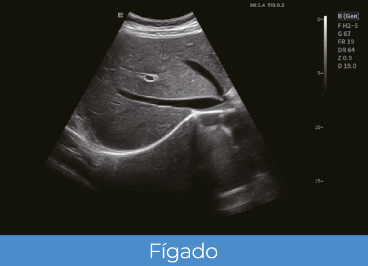 Sistema de Diagnóstico por Ultrassom Acclarix LX85 Innocare.DR - Fígado