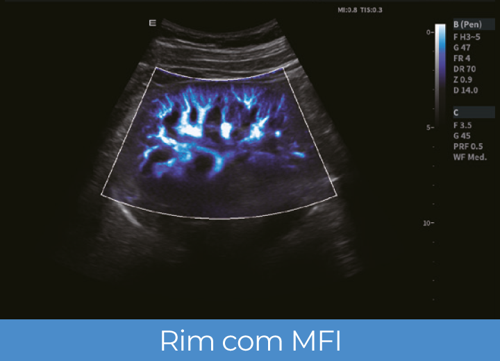 Sistema de Diagnóstico por Ultrassom Acclarix LX85 Innocare.DR - Rim com MFI