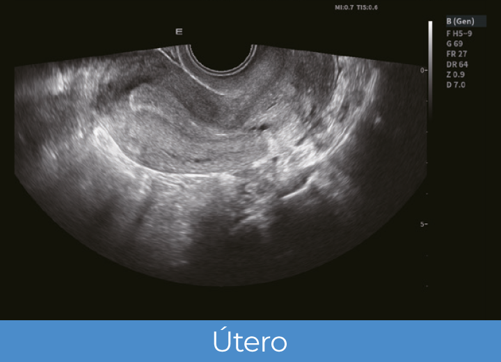Sistema de Diagnóstico por Ultrassom Acclarix LX85 Innocare.DR - Útero
