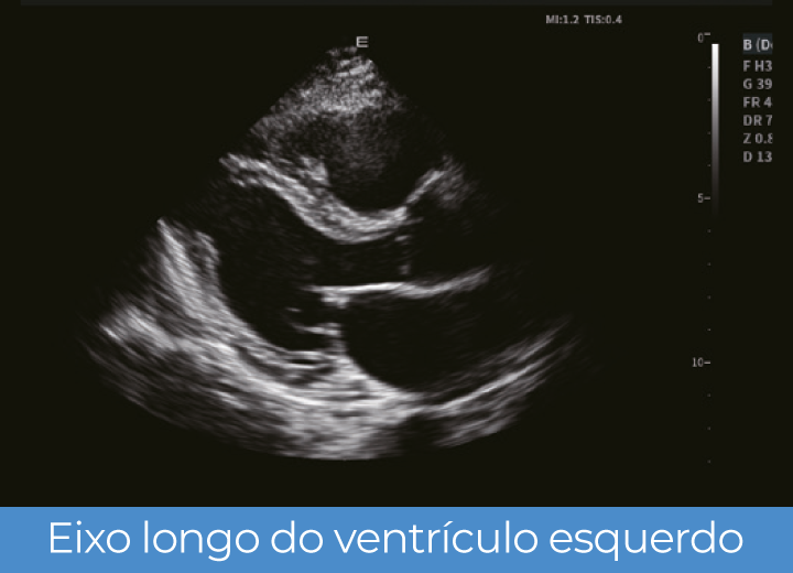 Sistema de Diagnóstico por Ultrassom Acclarix LX85 Innocare.DR - Eixo longo do ventrículo esquerdo